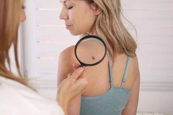 What Are Traditional Skin Lesion Removal Methods Witney?