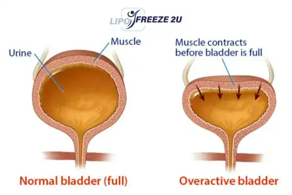 diagram of overactive bladder treatment Witney