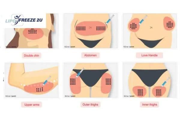 Benefits of Choosing Aqualyx for Fat Reduction Witney