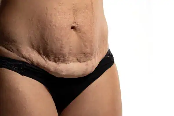 loose skin after weight loss injections Witney