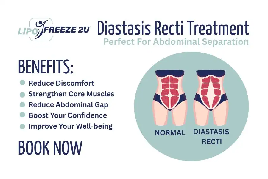 Benefits of body toning treatment Witney for Diastasis recti