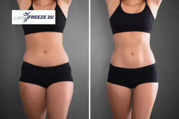 How Can LIPO FREEZE 2U Support Your Post-Pregnancy Body Recovery Witney?