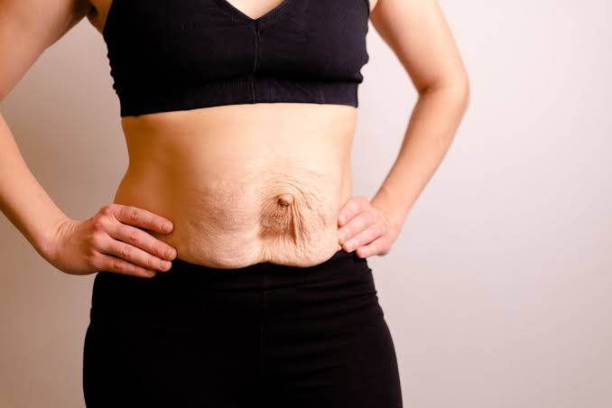Is Surgery Really the Only Way to Repair Diastasis Recti Witney?