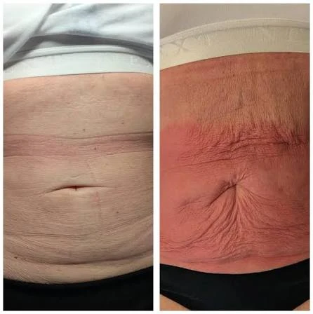 How Does RF Microneedling Improve Crepey, Thin and Uneven Skin Texture Witney?