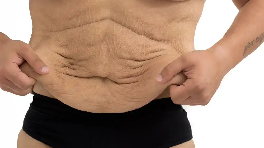 RF Microneedling for Loose Skin: How Can It Help Tighten and Reshape the Skin Witney?